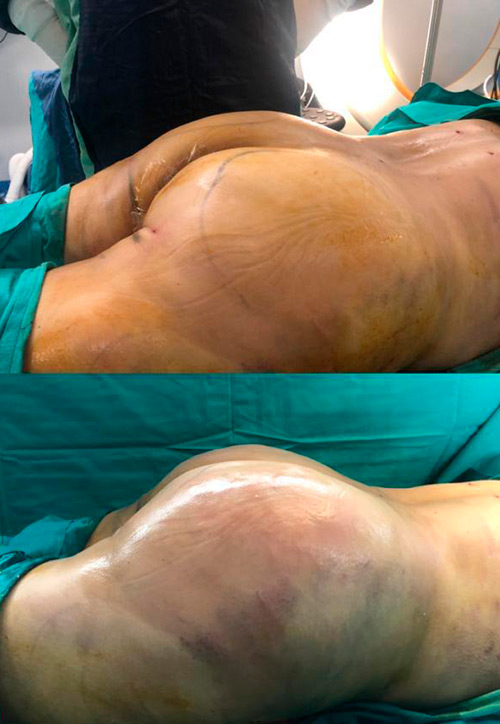 Mastopexia con implante de protesis mamario