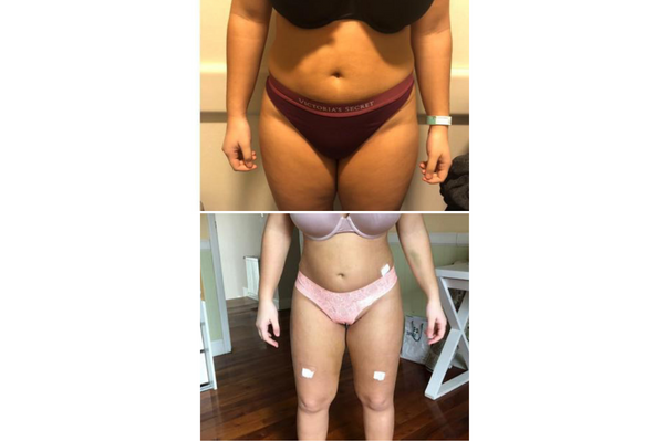 Lipoaspiración